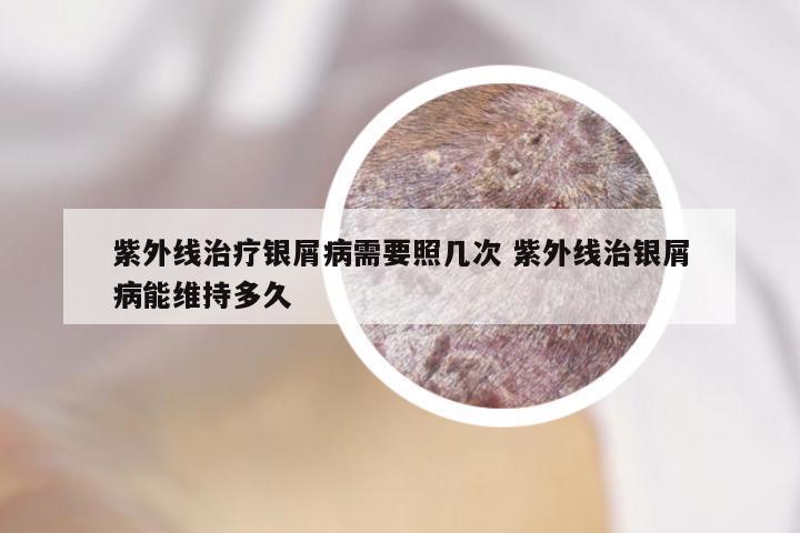 紫外线治疗银屑病需要照几次 紫外线治银屑病能维持多久