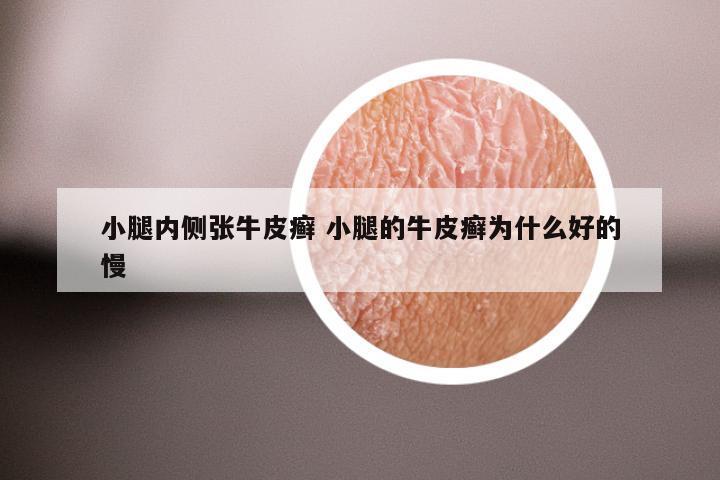 小腿内侧张牛皮癣 小腿的牛皮癣为什么好的慢
