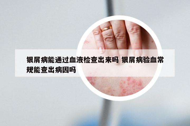银屑病能通过血液检查出来吗 银屑病验血常规能查出病因吗