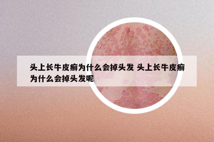 头上长牛皮癣为什么会掉头发 头上长牛皮癣为什么会掉头发呢