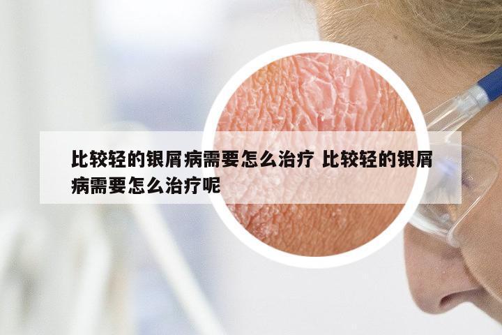 比较轻的银屑病需要怎么治疗 比较轻的银屑病需要怎么治疗呢