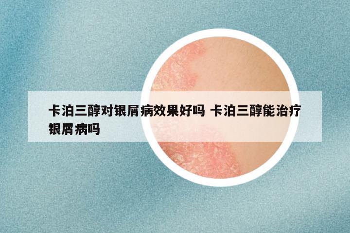 卡泊三醇对银屑病效果好吗 卡泊三醇能治疗银屑病吗
