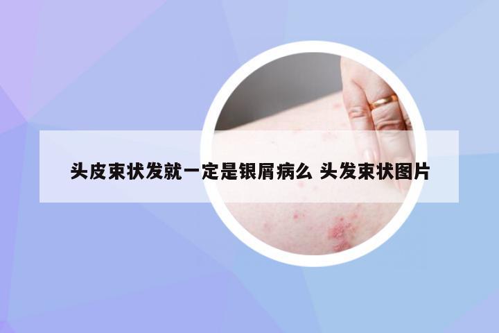 头皮束状发就一定是银屑病么 头发束状图片
