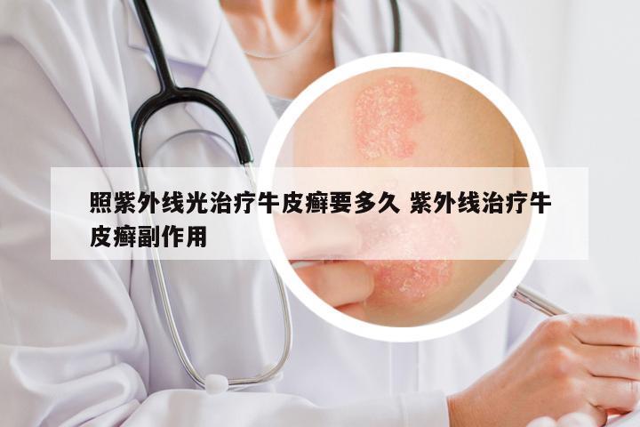 照紫外线光治疗牛皮癣要多久 紫外线治疗牛皮癣副作用