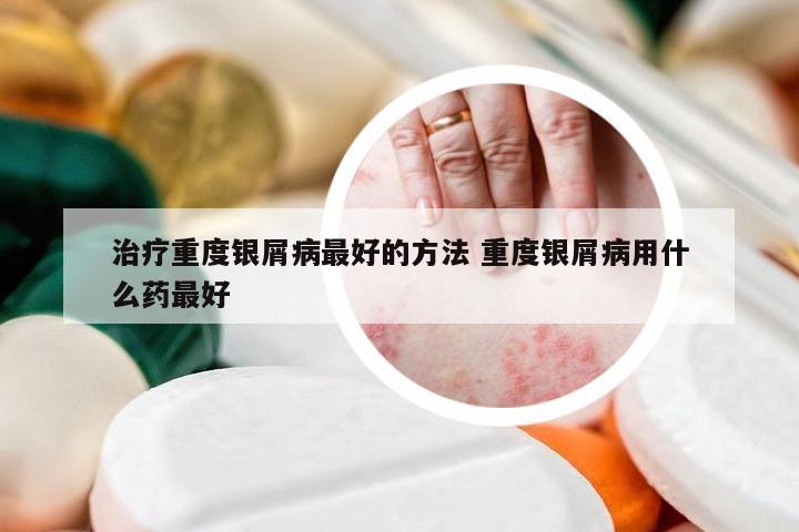 治疗重度银屑病最好的方法 重度银屑病用什么药最好
