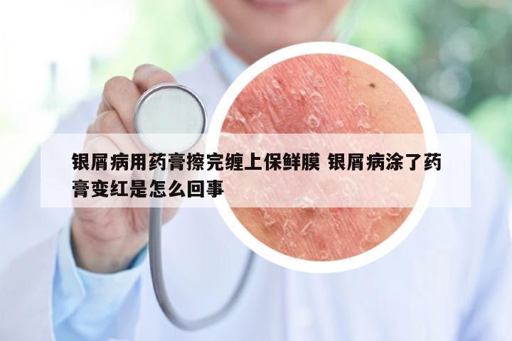 银屑病用药膏擦完缠上保鲜膜 银屑病涂了药膏变红是怎么回事