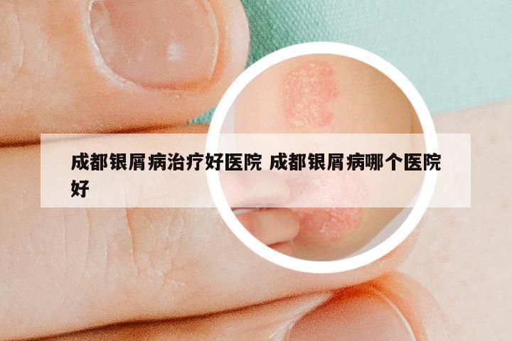 成都银屑病治疗好医院 成都银屑病哪个医院好