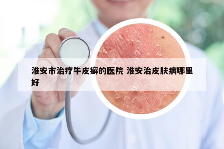 淮安市治疗牛皮癣的医院 淮安治皮肤病哪里好