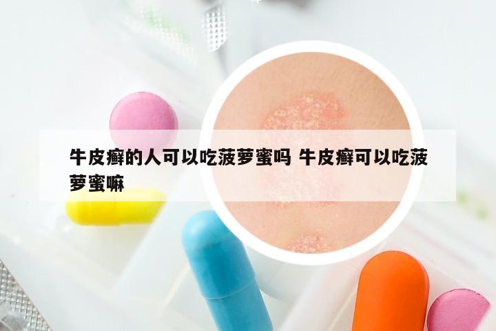 牛皮癣的人可以吃菠萝蜜吗 牛皮癣可以吃菠萝蜜嘛