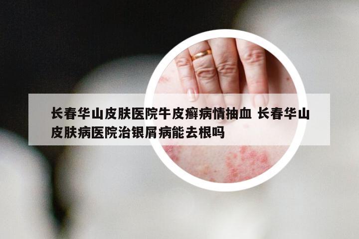 长春华山皮肤医院牛皮癣病情抽血 长春华山皮肤病医院治银屑病能去根吗