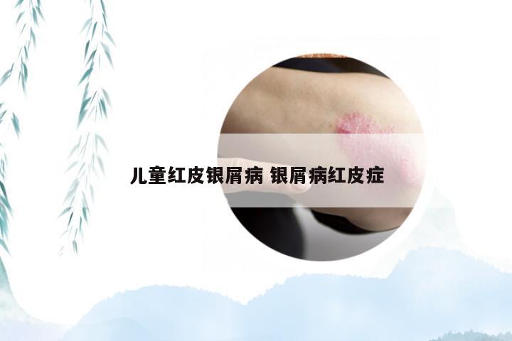 儿童红皮银屑病 银屑病红皮症