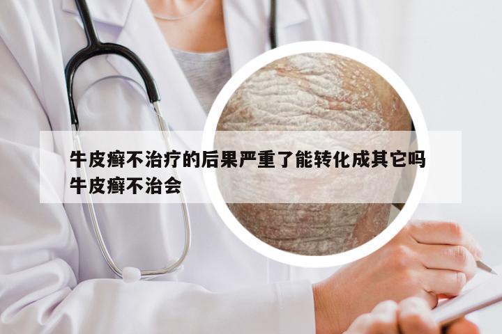 牛皮癣不治疗的后果严重了能转化成其它吗 牛皮癣不治会