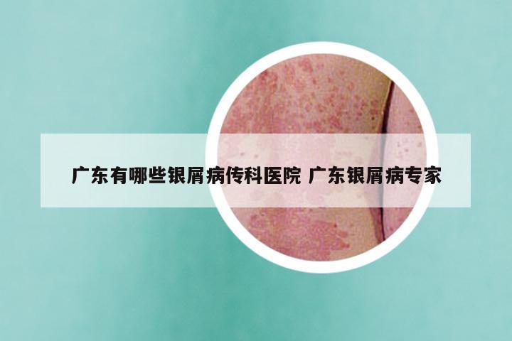 广东有哪些银屑病传科医院 广东银屑病专家