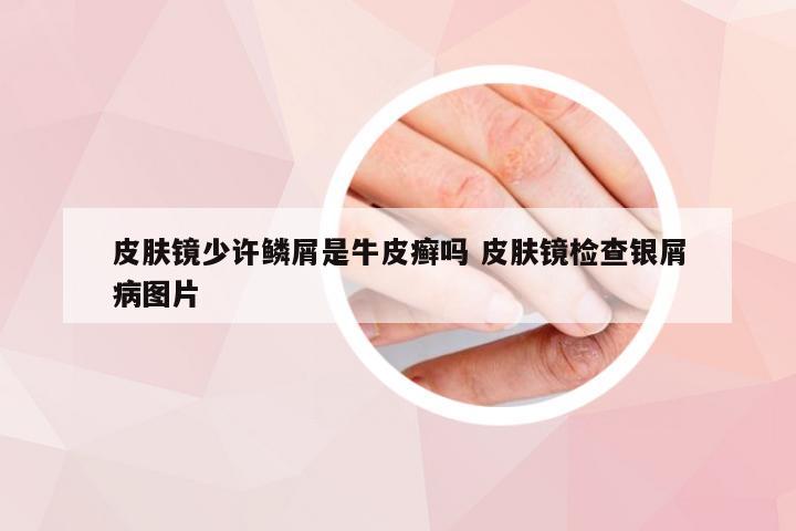 皮肤镜少许鳞屑是牛皮癣吗 皮肤镜检查银屑病图片
