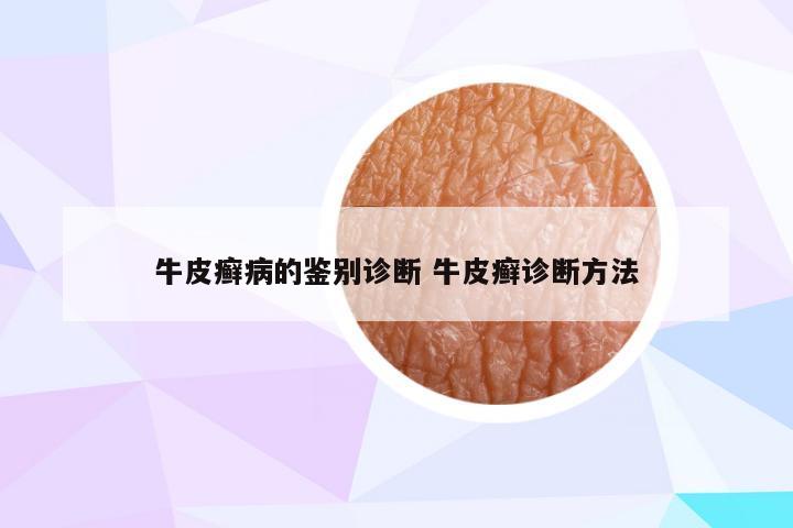 牛皮癣病的鉴别诊断 牛皮癣诊断方法