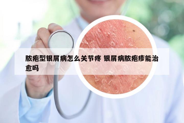 脓疱型银屑病怎么关节疼 银屑病脓疱疹能治愈吗