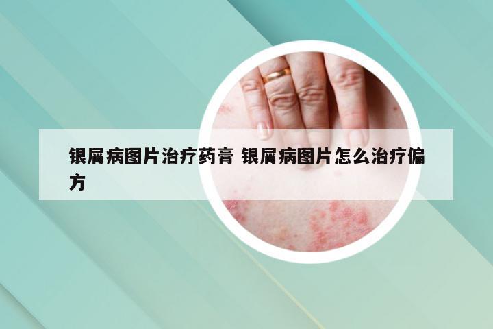 银屑病图片治疗药膏 银屑病图片怎么治疗偏方