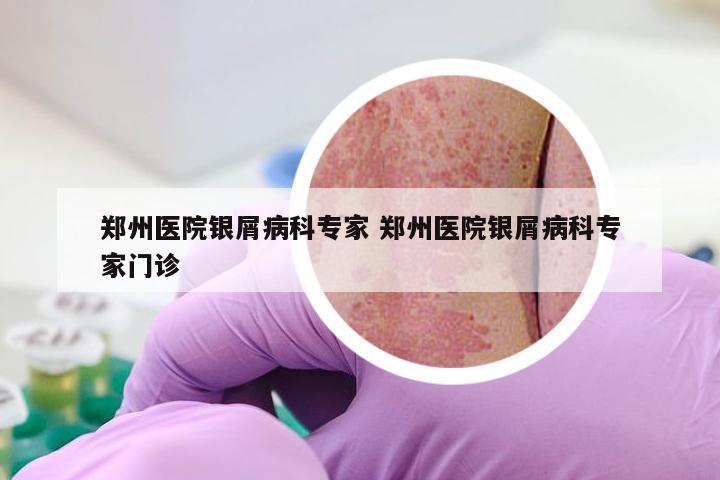 郑州医院银屑病科专家 郑州医院银屑病科专家门诊