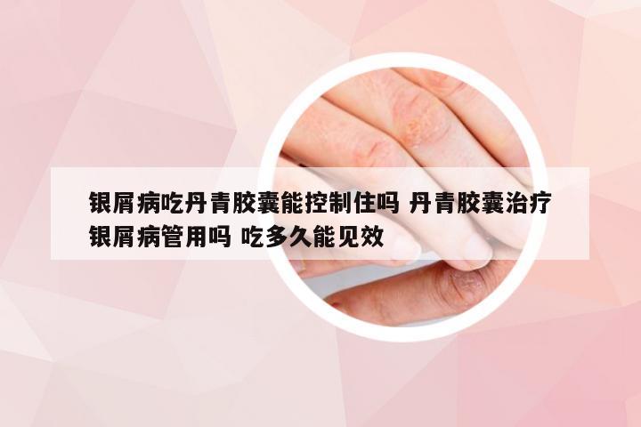 银屑病吃丹青胶囊能控制住吗 丹青胶囊治疗银屑病管用吗 吃多久能见效