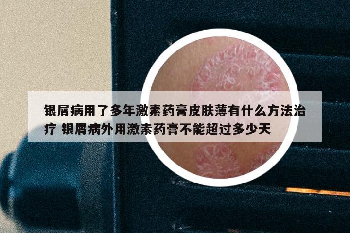 银屑病用了多年激素药膏皮肤薄有什么方法治疗 银屑病外用激素药膏不能超过多少天