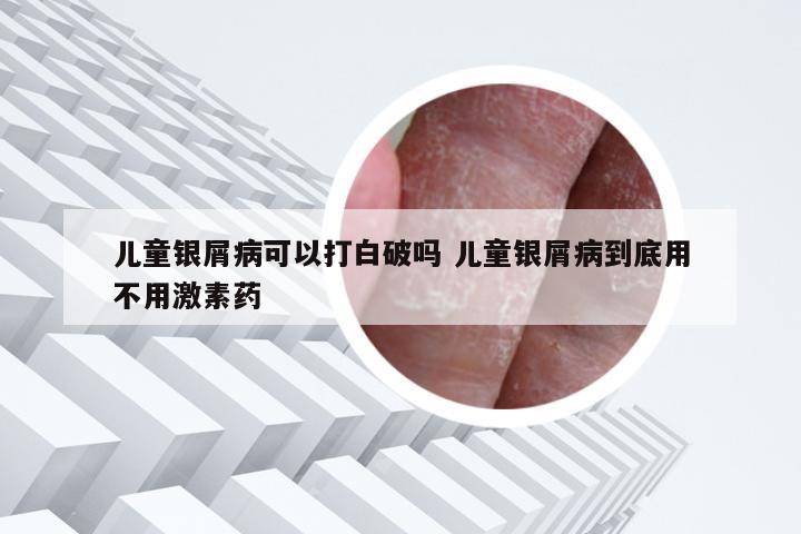 儿童银屑病可以打白破吗 儿童银屑病到底用不用激素药