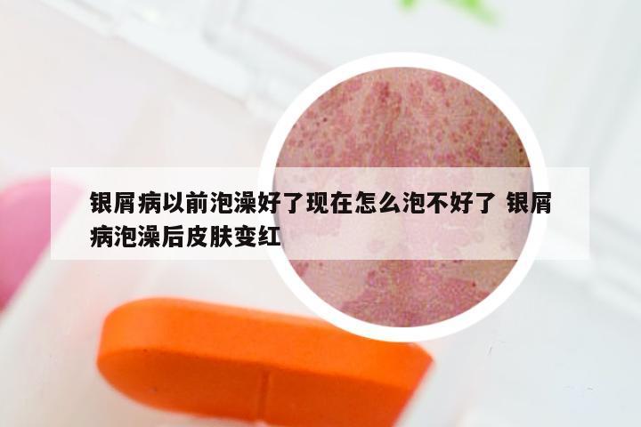 银屑病以前泡澡好了现在怎么泡不好了 银屑病泡澡后皮肤变红
