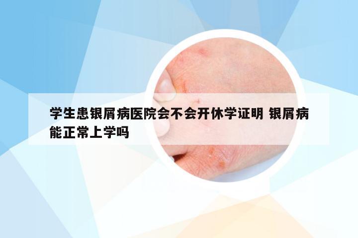学生患银屑病医院会不会开休学证明 银屑病能正常上学吗