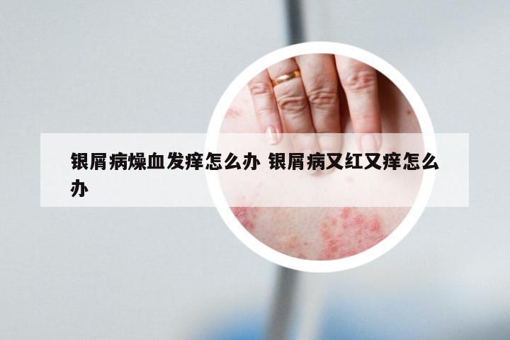银屑病燥血发痒怎么办 银屑病又红又痒怎么办