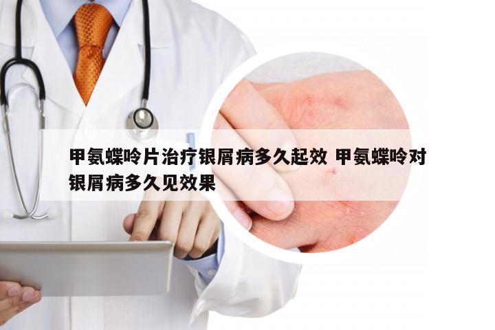 甲氨蝶呤片治疗银屑病多久起效 甲氨蝶呤对银屑病多久见效果