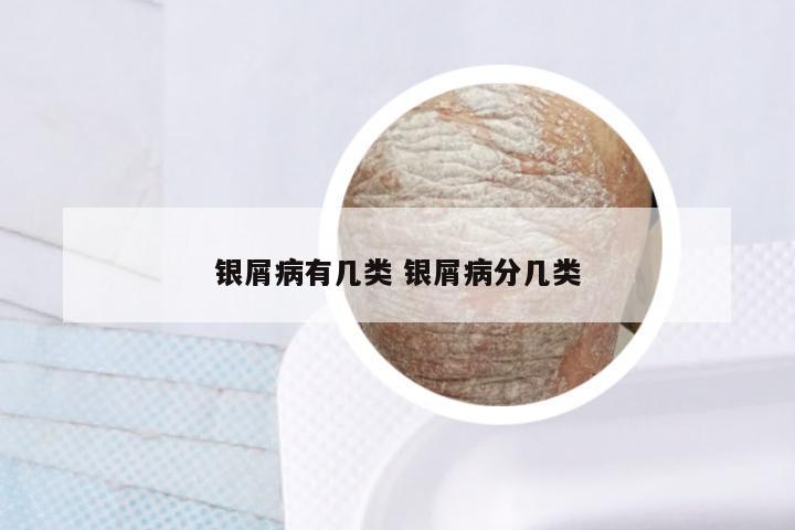 银屑病有几类 银屑病分几类