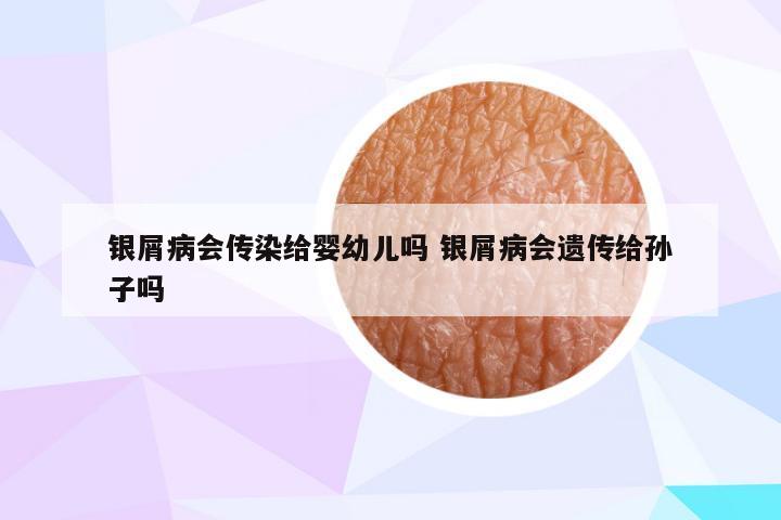 银屑病会传染给婴幼儿吗 银屑病会遗传给孙子吗