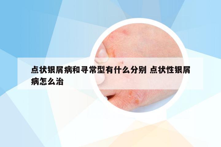 点状银屑病和寻常型有什么分别 点状性银屑病怎么治