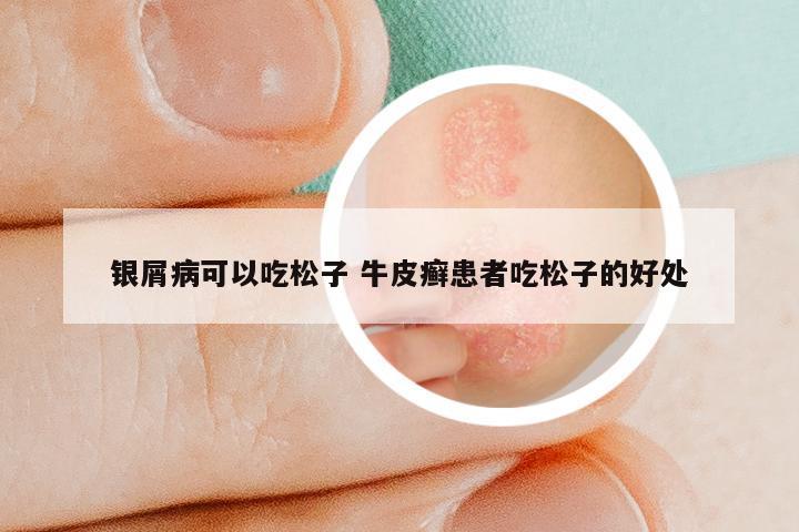 银屑病可以吃松子 牛皮癣患者吃松子的好处