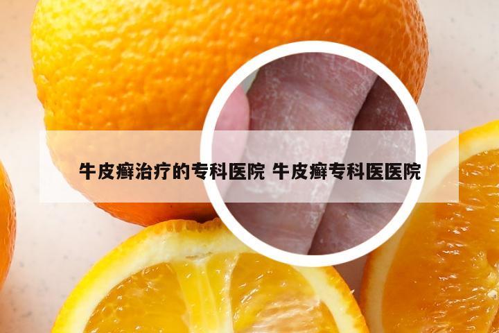 牛皮癣治疗的专科医院 牛皮癣专科医医院