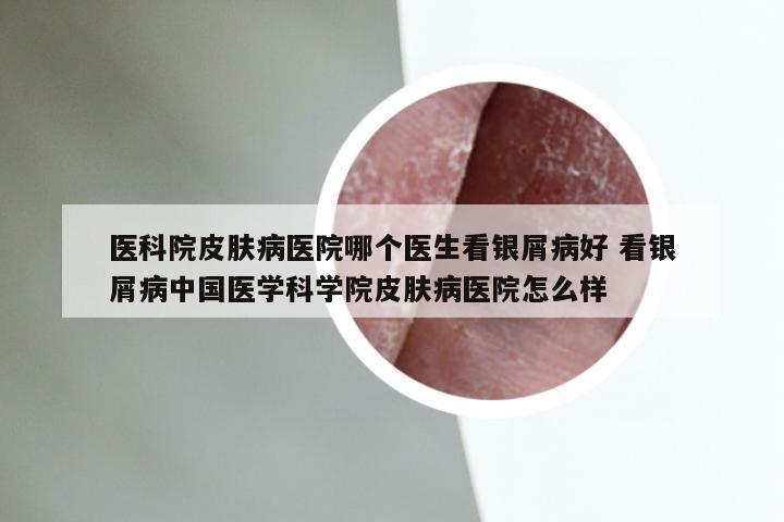 医科院皮肤病医院哪个医生看银屑病好 看银屑病中国医学科学院皮肤病医院怎么样