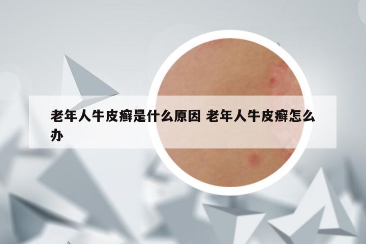 老年人牛皮癣是什么原因 老年人牛皮癣怎么办