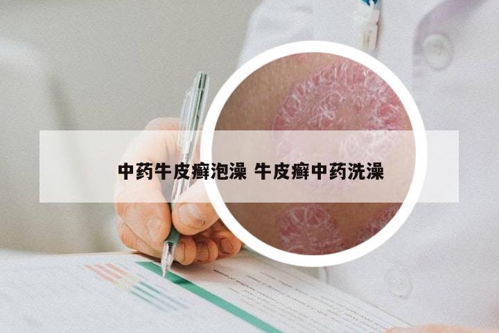 中药牛皮癣泡澡 牛皮癣中药洗澡