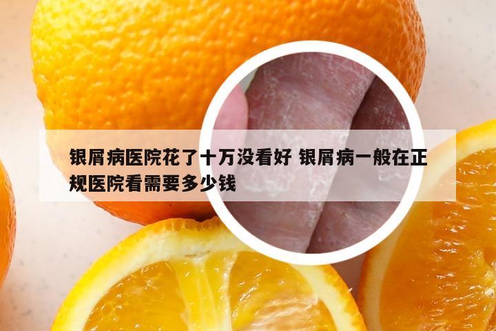 银屑病医院花了十万没看好 银屑病一般在正规医院看需要多少钱