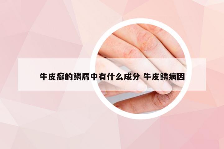 牛皮癣的鳞屑中有什么成分 牛皮鳞病因