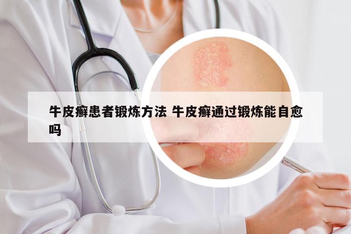 牛皮癣患者锻炼方法 牛皮癣通过锻炼能自愈吗