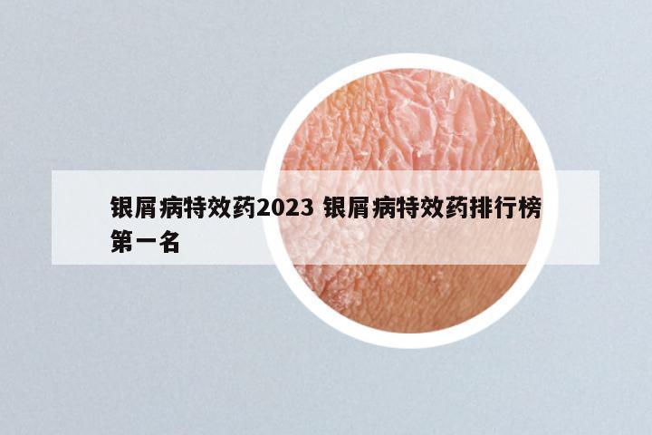 银屑病特效药2023 银屑病特效药排行榜第一名