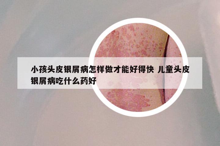 小孩头皮银屑病怎样做才能好得快 儿童头皮银屑病吃什么药好