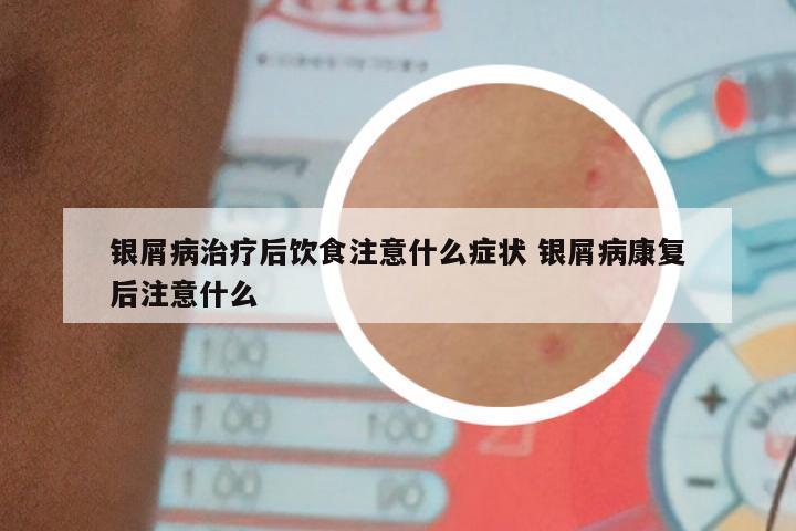 银屑病治疗后饮食注意什么症状 银屑病康复后注意什么