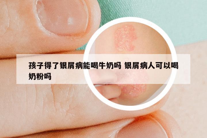 孩子得了银屑病能喝牛奶吗 银屑病人可以喝奶粉吗