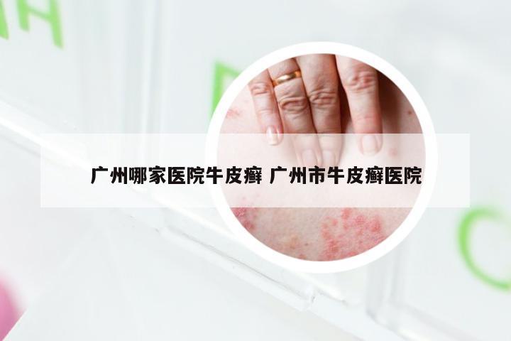 广州哪家医院牛皮癣 广州市牛皮癣医院