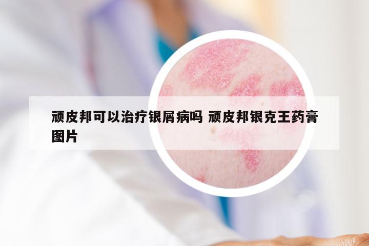 顽皮邦可以治疗银屑病吗 顽皮邦银克王药膏图片