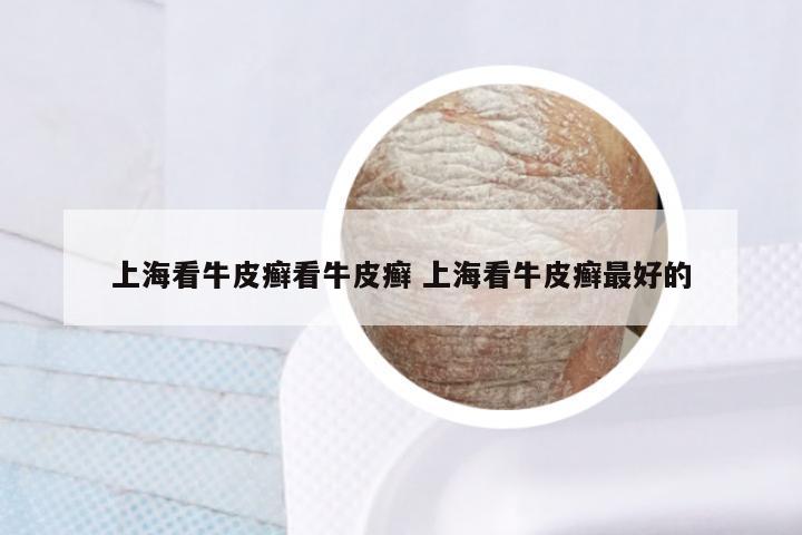 上海看牛皮癣看牛皮癣 上海看牛皮癣最好的