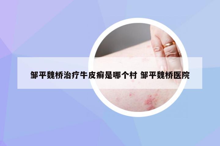 邹平魏桥治疗牛皮癣是哪个村 邹平魏桥医院