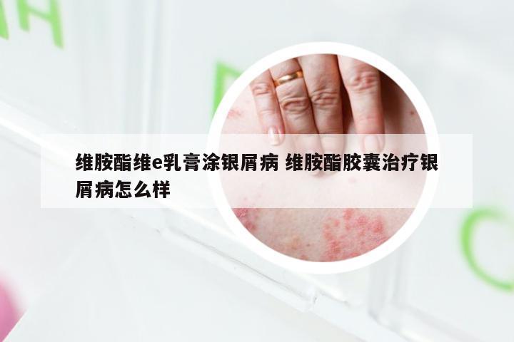 维胺酯维e乳膏涂银屑病 维胺酯胶囊治疗银屑病怎么样