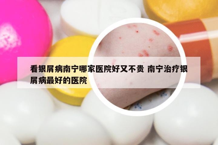 看银屑病南宁哪家医院好又不贵 南宁治疗银屑病最好的医院